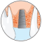 Internal Sinus Lifting